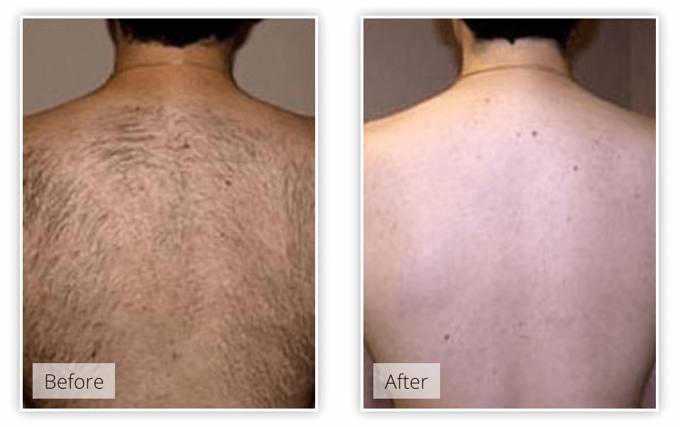 laser hair removal - benefits